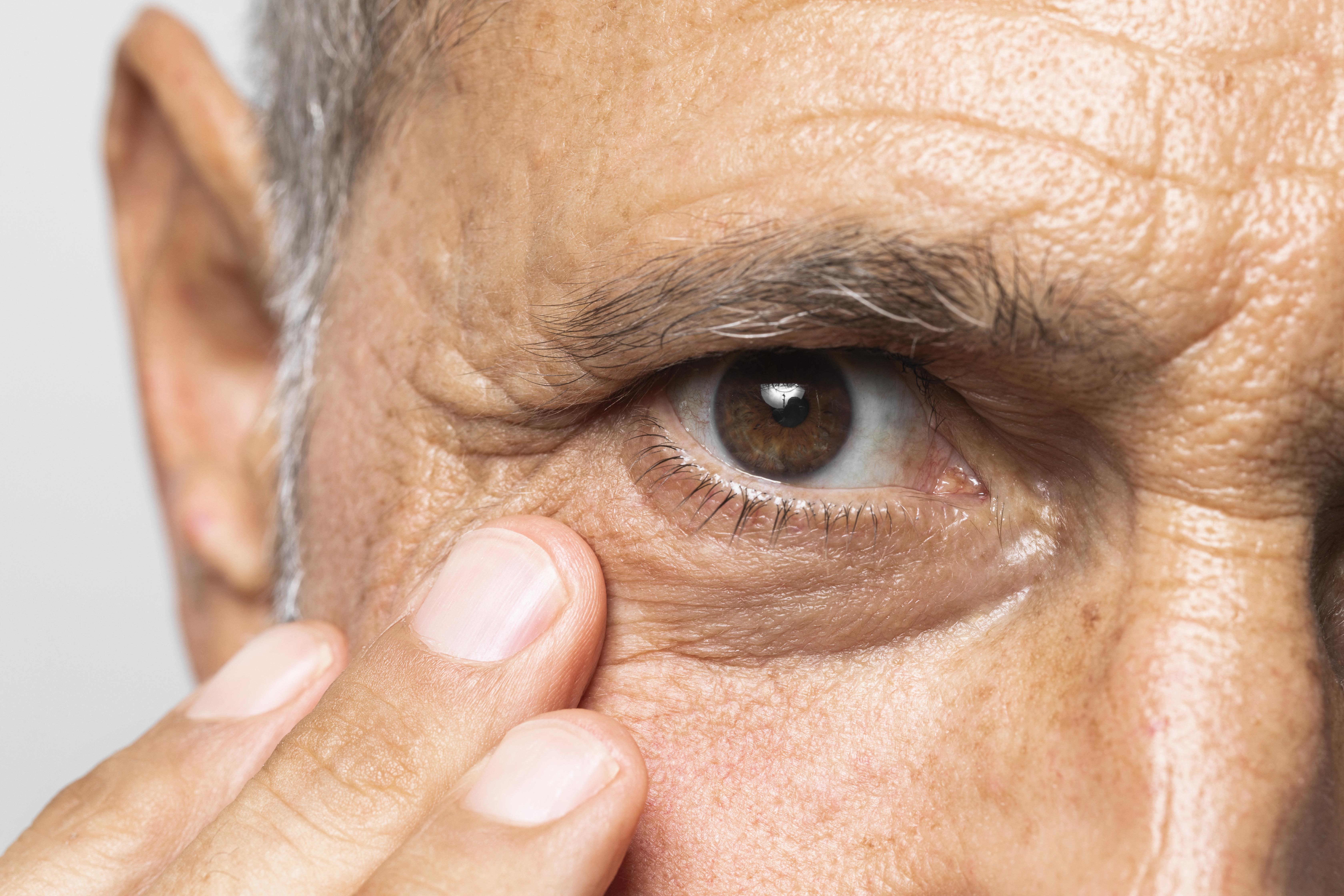 Macular Degeneration